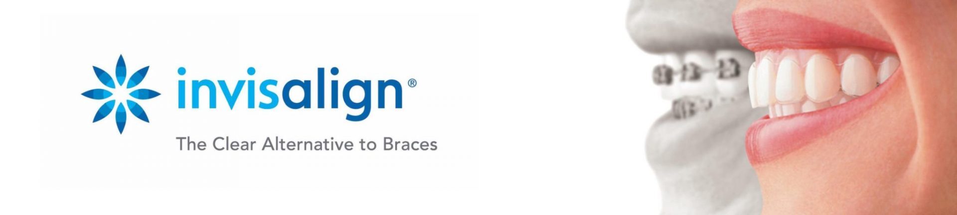 INVISALIGN